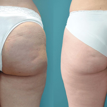 Women Buttocks BTL-Cellulite-Reduction before after | RenovoMD in Northborough, MA