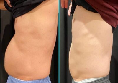 CoolSculpting-Male-two-rounds-four-cycles-side-RenovoMD