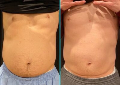 CoolSculpting-two-Rounds-four-Cycles-Front-RenovoMD
