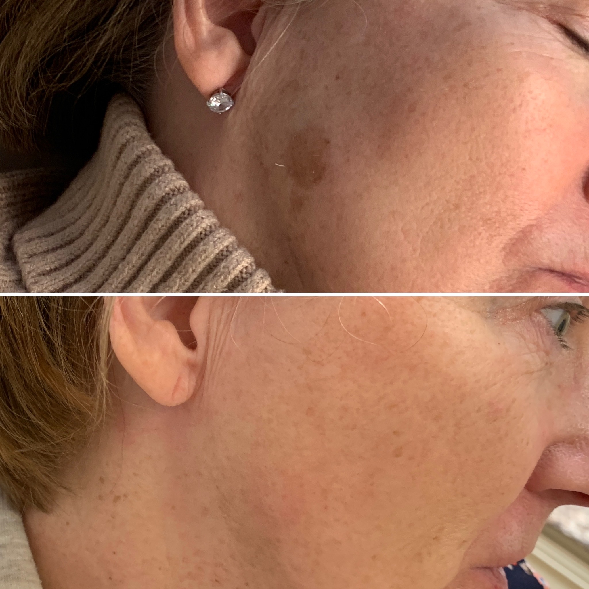 Laser-Skin-Resurfacing Treatment Before After | RenovoMD in Northborough, MA