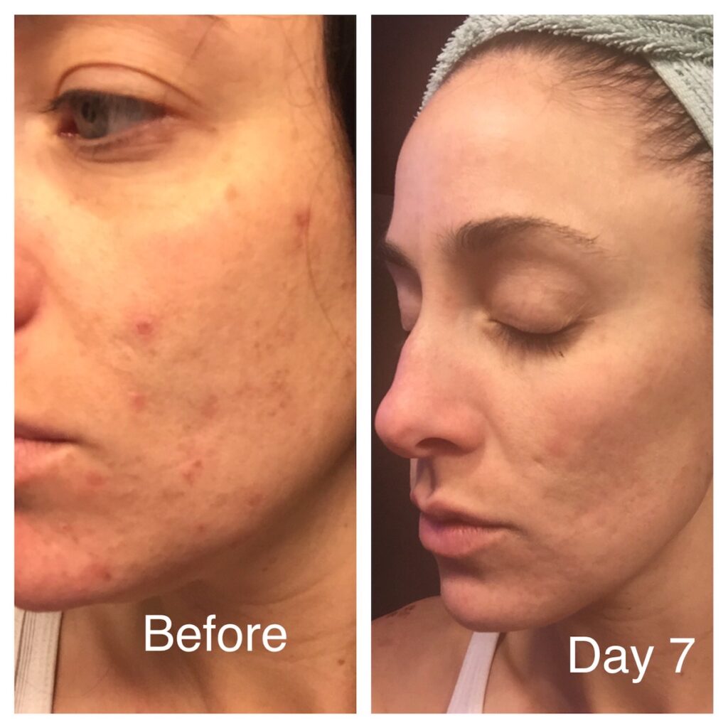 PCA Chemical Peel with Microtox | RenovoMD in Northborough, MA