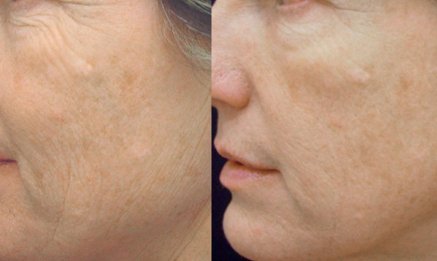 Pellieve Skin Tightening wrinkles before after | RenovoMD in Northborough, MA