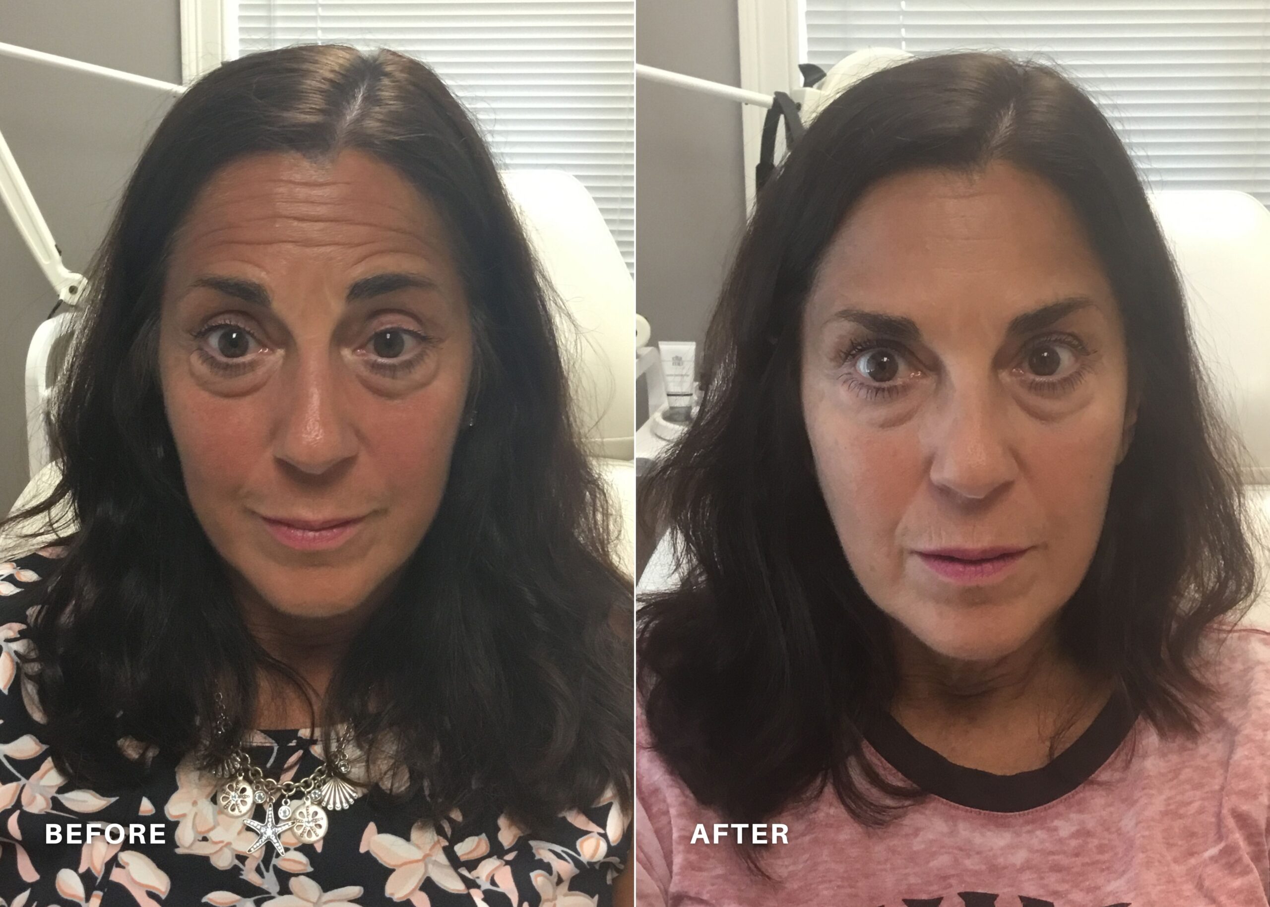 before_and_after_botox_renovo_md