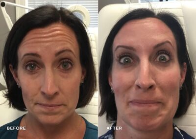 botox_before_&_after_renovo_md