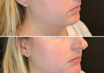 chin_filler_renovo_md_before_and_after