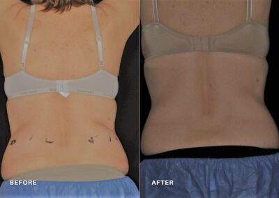 coolsculpting_before_and_after_renovo_md