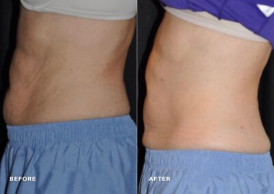 coolsculpting_renovo_md_before_and_after