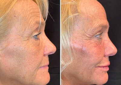 filler_renovo_md_before_and_after
