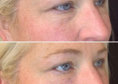 filler_renovo_md_before_and_after_images