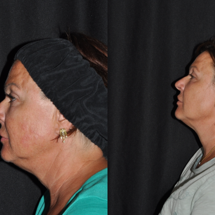 Women kybella Treatment before after | RenovoMD in Northborough, MA