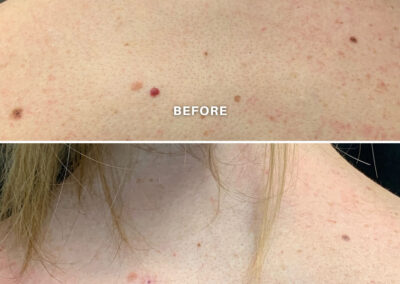 Women Laser-Skin-Resurfacing Treatment Before After | RenovoMD in Northborough, MA