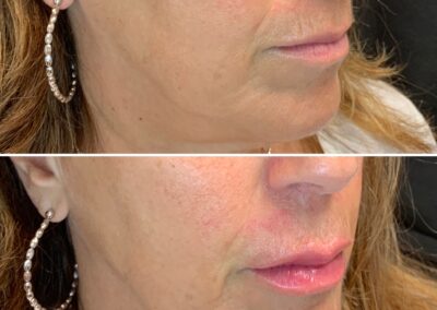 lip_augmentation_before_and_after_renovomd