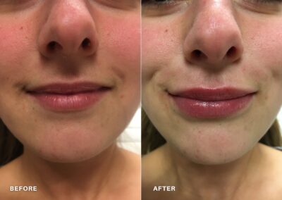 lip_filler_before_and_after_renovo_md