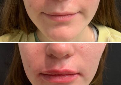 lip_filler_renovo_md_before_and_after