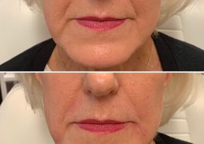 lip_folds_renovo_md_filler_before_and_after