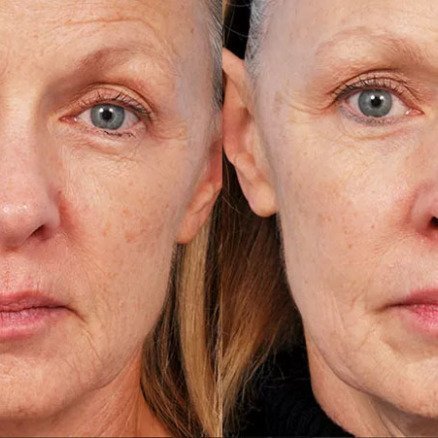 Pelleve-skin-tightening-eyes before after | RenovoMD in Northborough, MA
