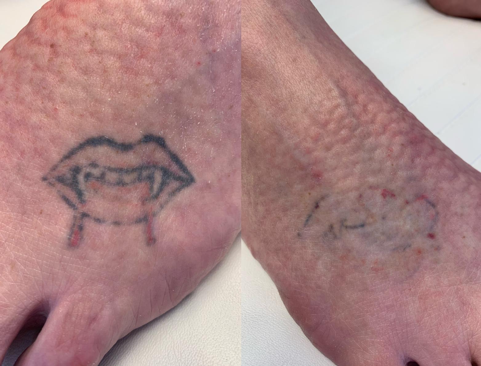 Tattoo-removal Treatment before after | RenovoMD in Northborough, MA
