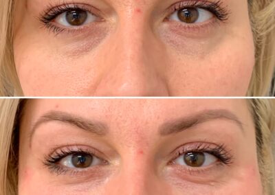 undereye_renovo_md_filler_before_and_after
