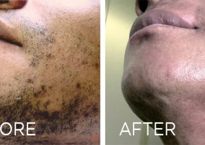 Electrolysis Before And After in Northborough, MA | RenovoMD