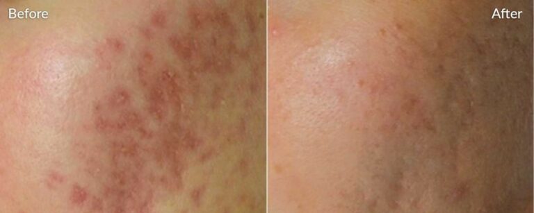 Skinpen-Microneedling-before-&-after