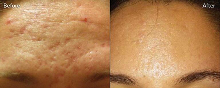 Skinpen-Microneedling-beforee-and-after