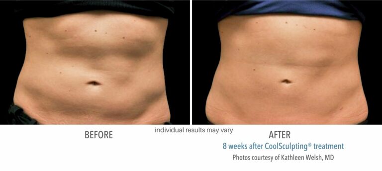 coolsculpting_before_and_after_stomach_Northborough_ma