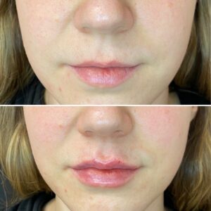dermal-fillers-in-northborough-ma-before-and-after-lips