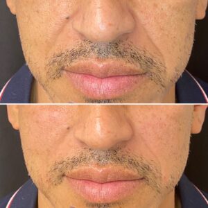dermal-fillers-in-northborough-ma-before-and-after-men-face
