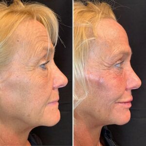 dermal-fillers-in-northborough-ma-before-and-after-side