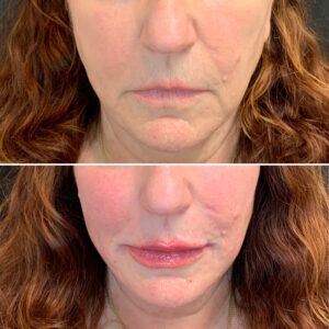 dermal-fillers-in-northborough-ma-before-and-after
