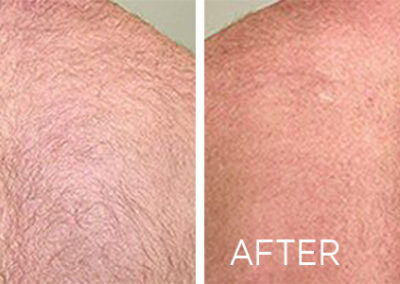 renovo-laser-hair-removal-before-and-after-arm