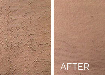 renovo-laser-hair-removal-before-and-after