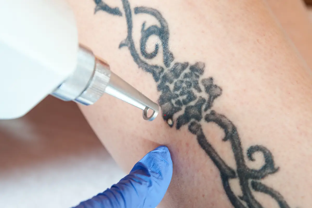 Tattoo Removal Treatment RENOVOMD in Northborough MA