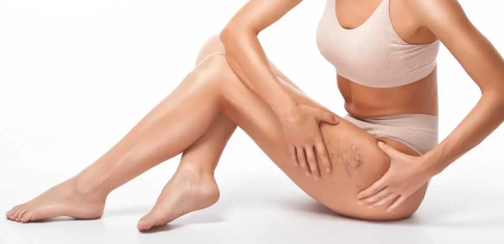 Spider Veins Removal Treatment by RenovoMD in Northborough, MA