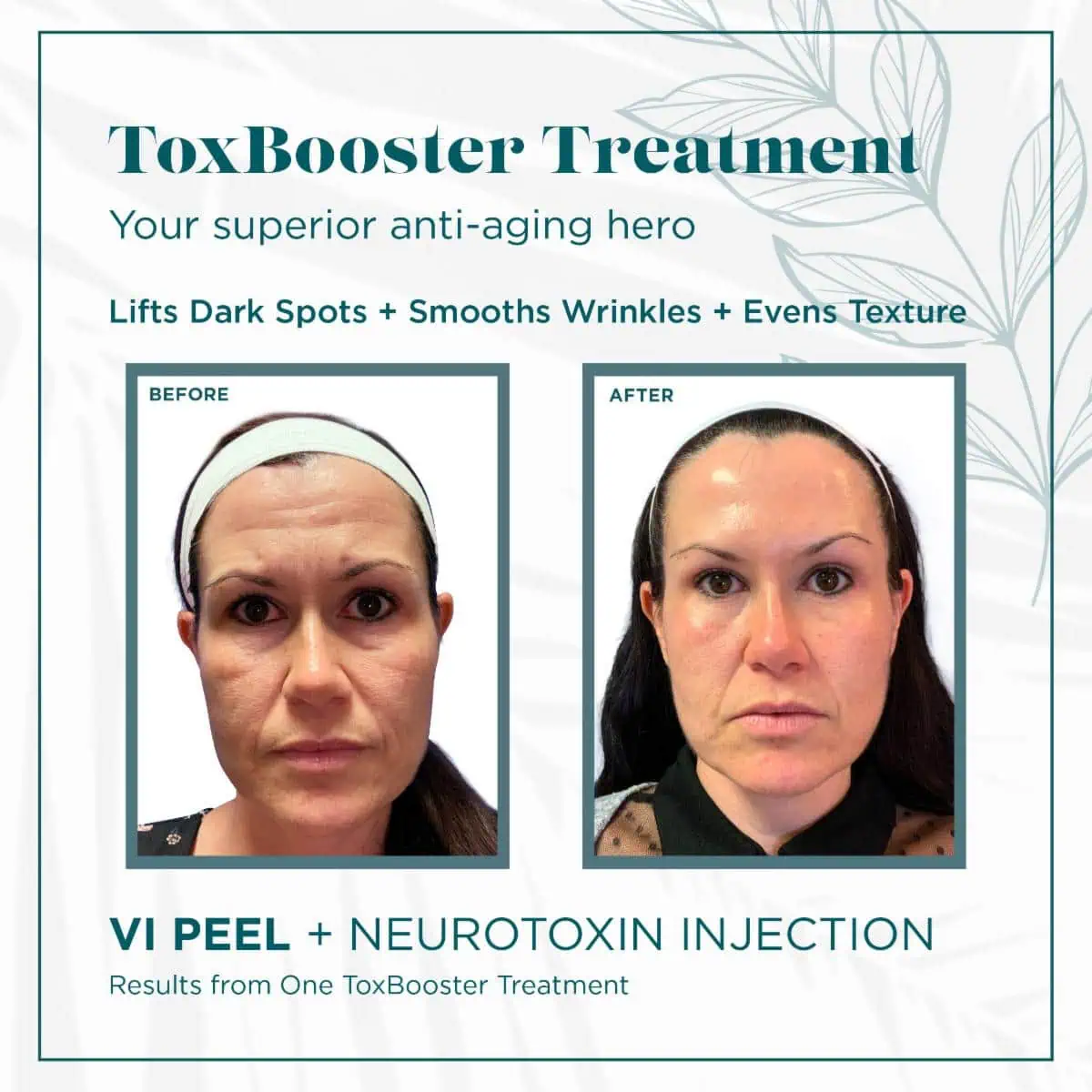 Toxbooster Treatment before & after in Northborough, MA