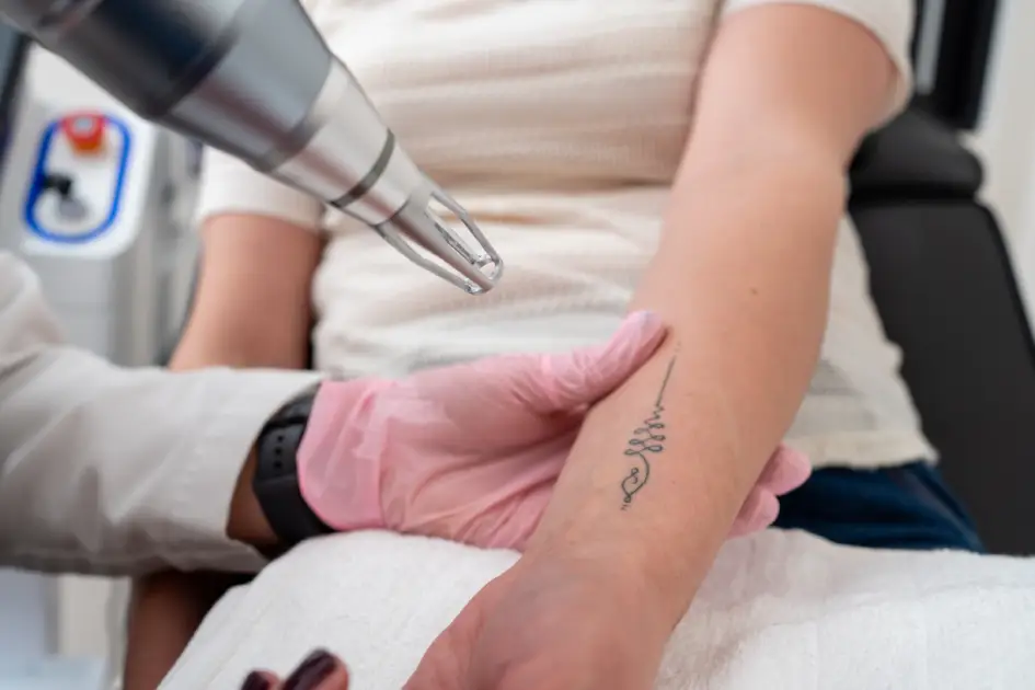 Top Benefits of Professional Tattoo Removal