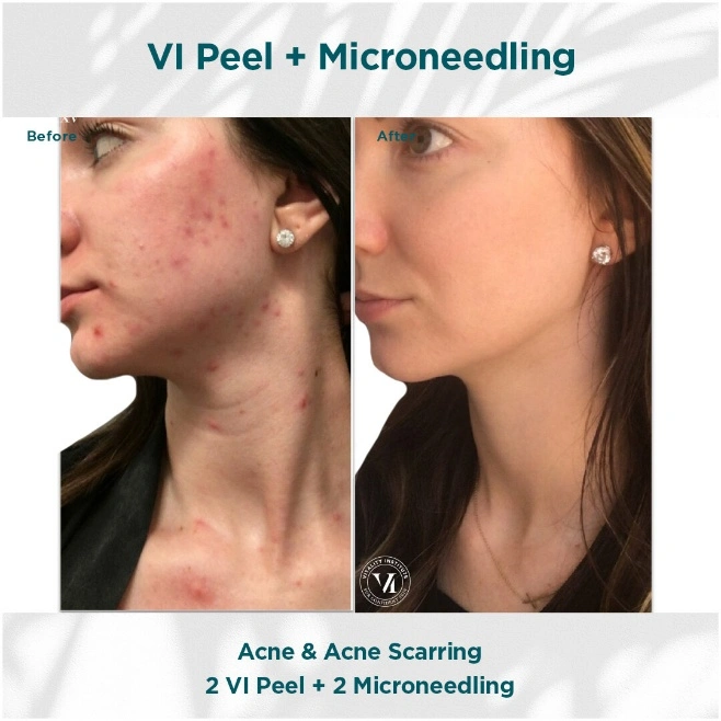 VI Peels in Northborough, MA