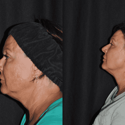Kybella-before-&-after-women in Northborough, MA
