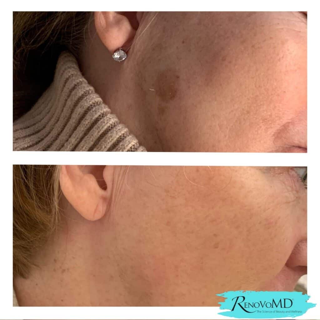 Laser-Skin-Resurfacing-before-and-after-treatment-Renovo-MD-MA