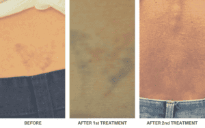 Laser_Tattoo_Removal in Northborough, MA