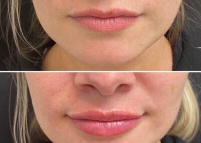 Before & after Image of face in Northborough, MA
