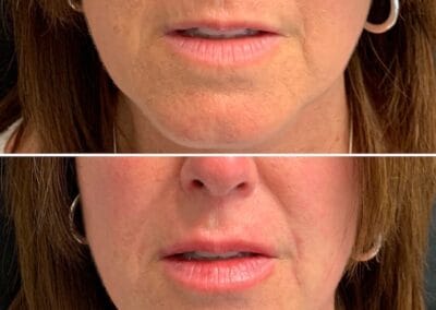 Before & after Image of face in Northborough, MA