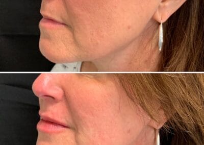 Before & after Image of face in Northborough, MA