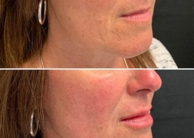Before & after Image of face in Northborough, MA