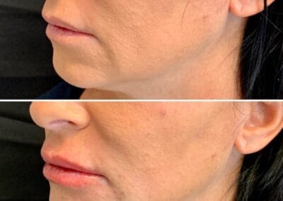 Before & after Image of face in Northborough, MA