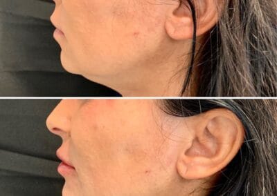 Before & after Image of face in Northborough, MA