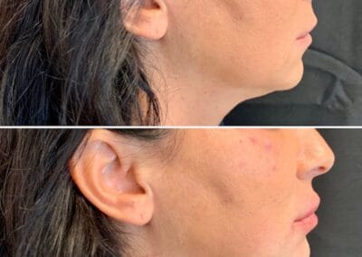 Before & after Image of face in Northborough, MA