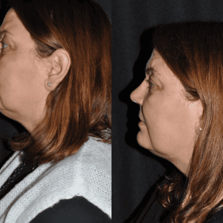 Kybella-before-&-after-women in Northborough, MA