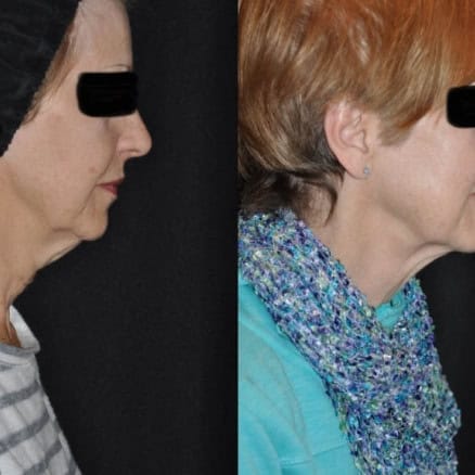 Women kybella Treatment before after | RenovoMD in Northborough, MA