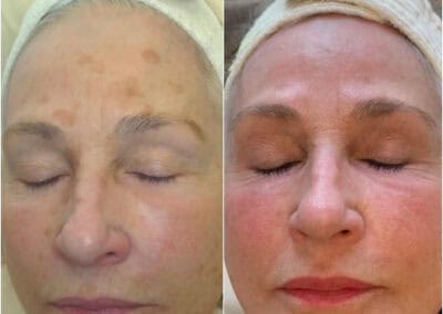 laser-skin-resurfacing-before-and-after-treatment-renovomd